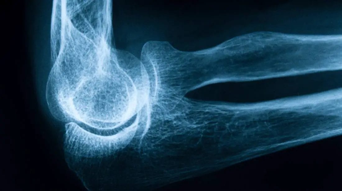 Decreases-Bone-loss Decreases Bone loss